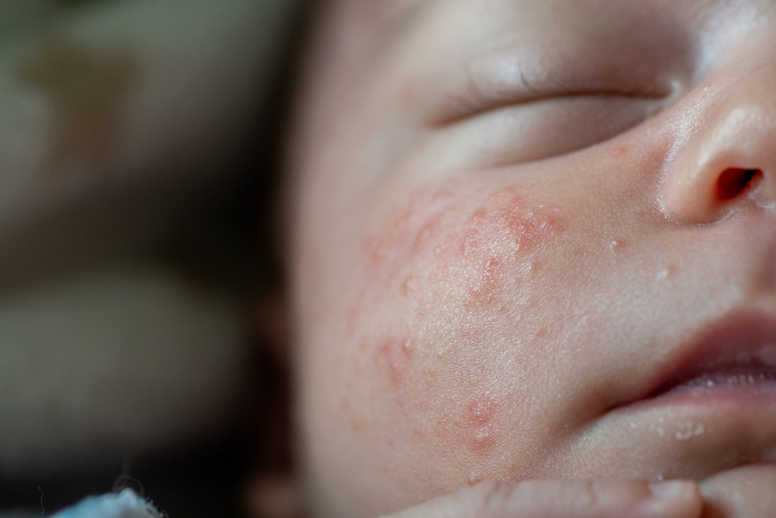 Baby Acne Rash: How To Tell The Difference, 52% OFF